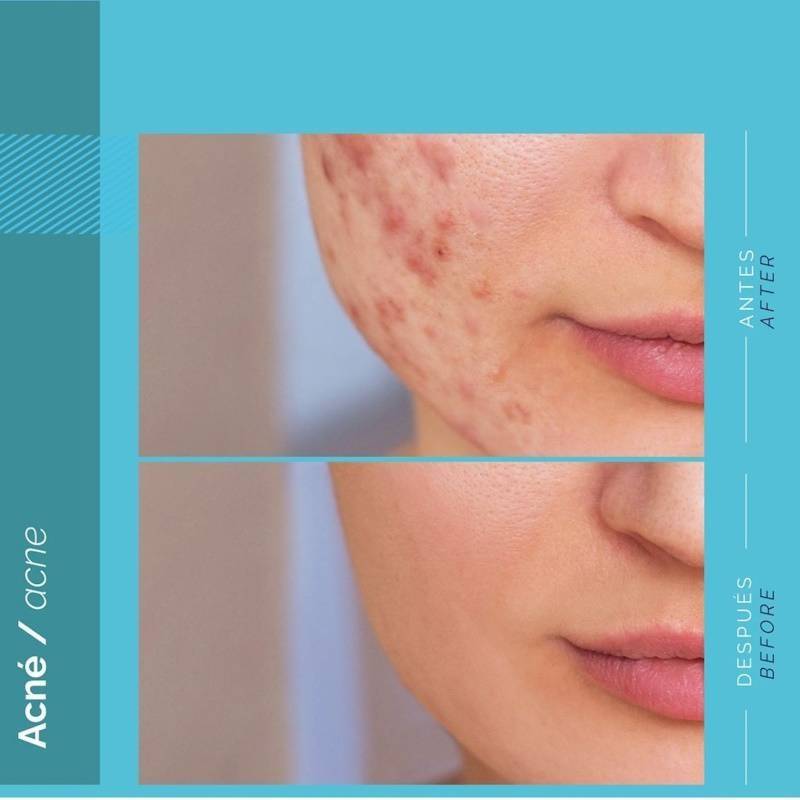 Tratamiento Acné